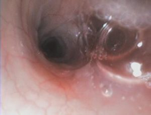 Endoscopia: Broncoscopia e lavagem broncoalveolar (imagem 2 de 2)