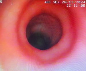 Endoscopia: Colonoscopia no diagnóstico de massa colo-retal (imagem 1 de 3)