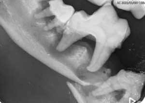 Dentisteria e Odontologia: Fraturas mandibulares e doença periodontal (imagem 1 de 2)