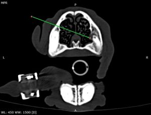 Dentisteria e Odontologia: Fístula oronasal por fratura dentária (imagem 2 de 2)