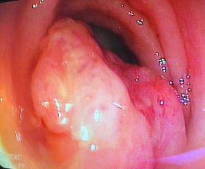 Endoscopia: Colonoscopia no diagnóstico de massa colo-retal (imagem 2 de 3)
