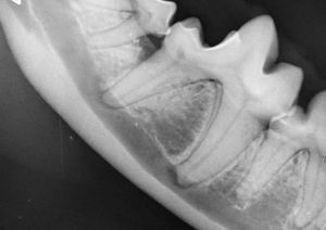 Dentisteria e Odontologia: Doença periodontal detetada por radiologia oral (imagem 2 de 2)