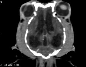 TAC: Hidrocefalia obstrutiva por estenose do aqueduto (imagem 3 de 3)