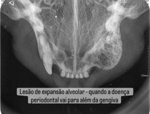 Dentisteria e Odontologia: Lesão alveolar por doença periodontal
