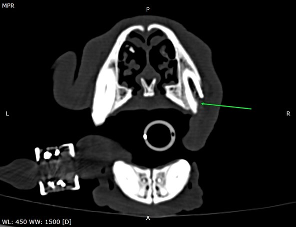 Fístula oronasal por fratura dentária