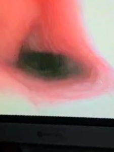 Endoscopia: Osso impactado no esófago removido por endoscopia (imagem 4 de 5)