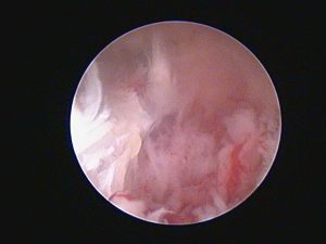 Oncologia: Carcinoma ceruminoso em gatos (imagem 2 de 3)