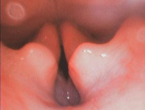 Endoscopia: Sacos laríngeos invertidos em braquicefálicos