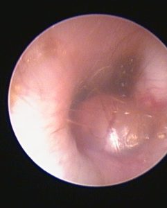 Endoscopia: Otite secretória em Cavalier King Charles (imagem 3 de 4)