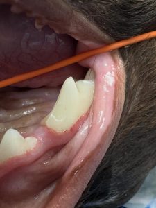 Dentisteria e Odontologia: Fratura dentária por objetos rígidos (imagem 3 de 5)