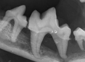 Dentisteria e Odontologia: Doença periodontal terminal em caso extremo (imagem 3 de 9)