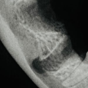 Dentisteria e Odontologia: Exodontia com raízes dilaceradas (imagem 3 de 3)