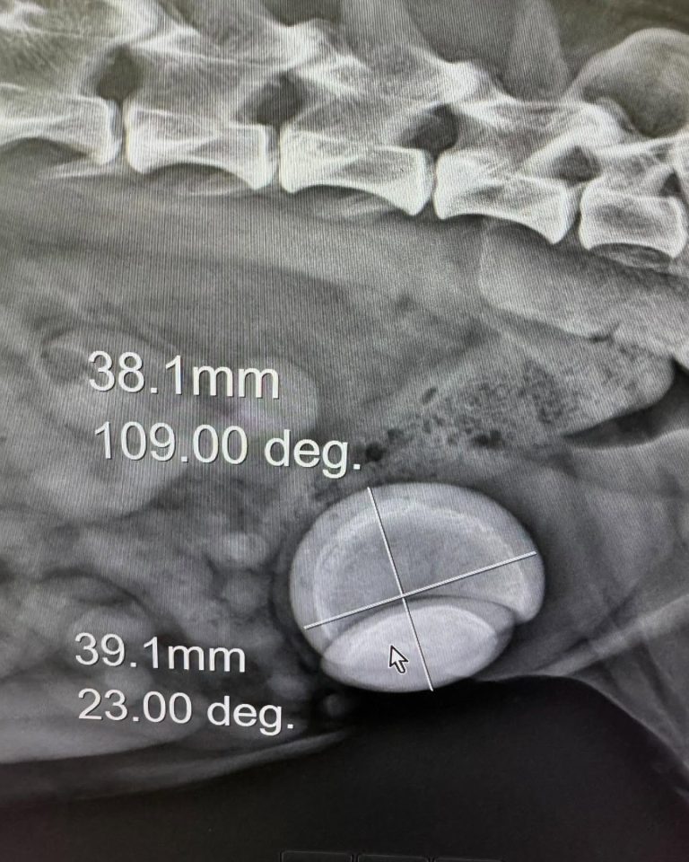 Radiologia: Urocistólitos de grandes dimensões (imagem 1 de 2)