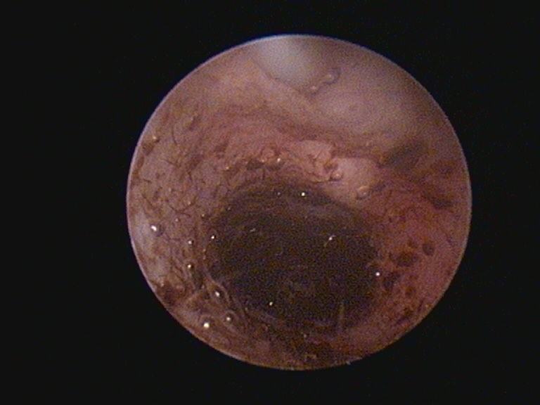 Endoscopia: Lavagem auricular em otites complicadas (imagem 1 de 2)