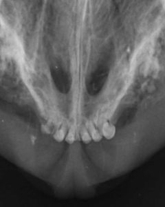 Dentisteria e Odontologia: Reabsorção dentária e fragmentos retidos (imagem 2 de 2)