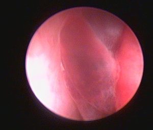 Oncologia: Carcinoma nasal em cão idoso (imagem 3 de 4)