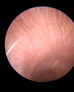 Endoscopia: Otite secretória em Cavalier King Charles (imagem 2 de 4)