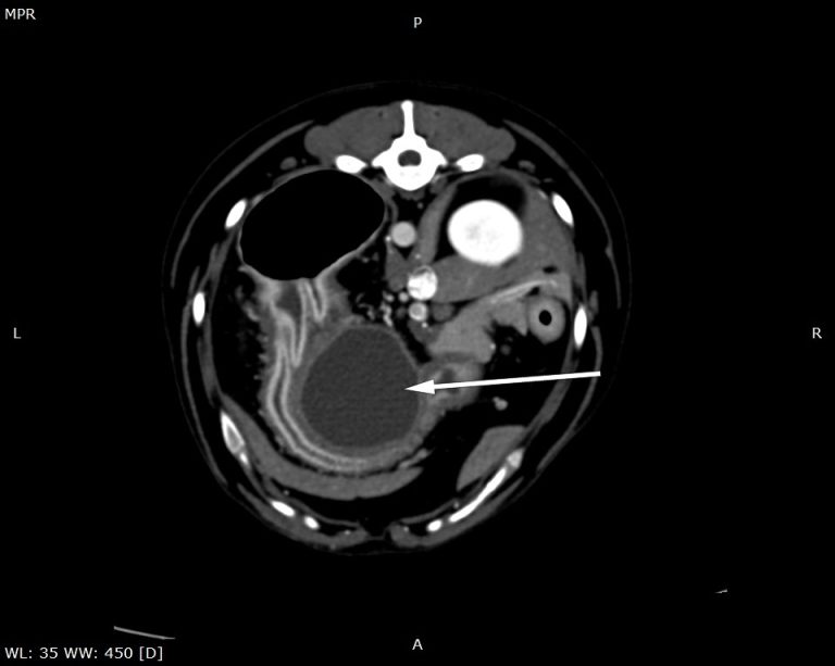 TAC: Pseudoquisto pancreático após pancreatite