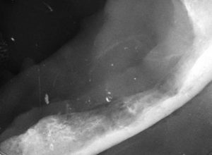 Dentisteria e Odontologia: Doença periodontal terminal em caso extremo (imagem 4 de 9)