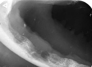 Dentisteria e Odontologia: Doença periodontal terminal em caso extremo (imagem 2 de 9)