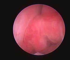 Oncologia: Carcinoma nasal em cão idoso (imagem 2 de 4)