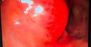 Oncologia: Leiomioma retal com obstrução intestinal (imagem 2 de 3)