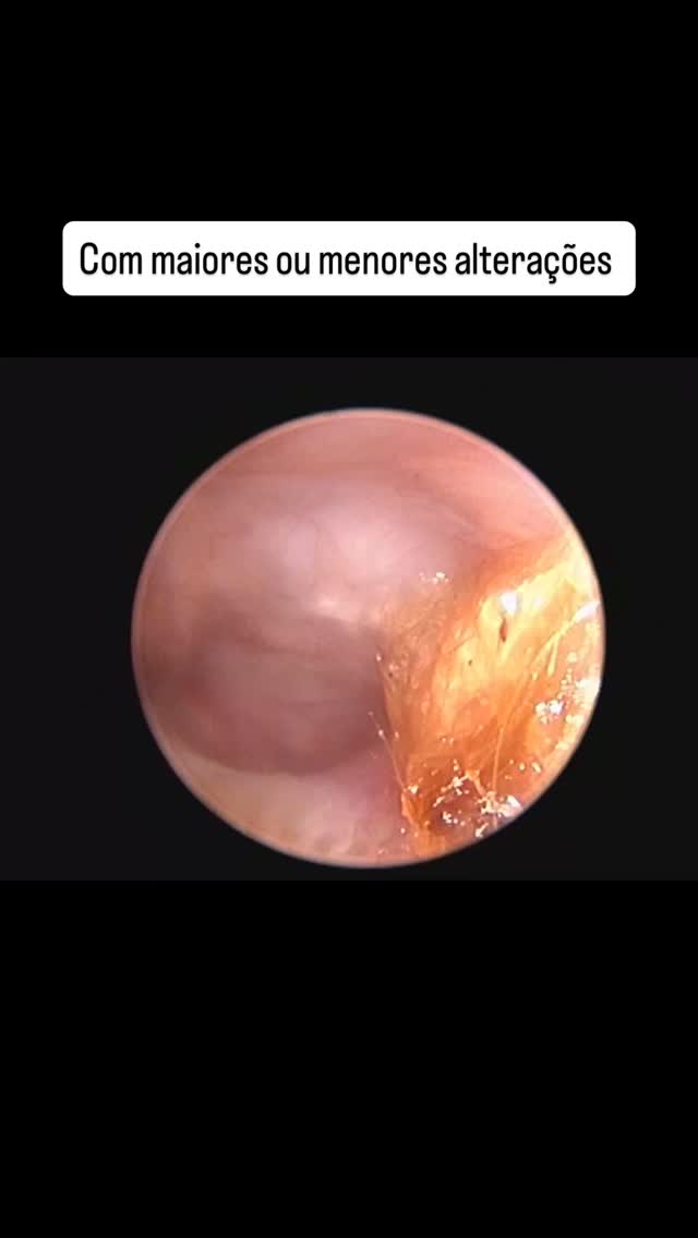 Endoscopia: Videotoscopia em otites crónicas