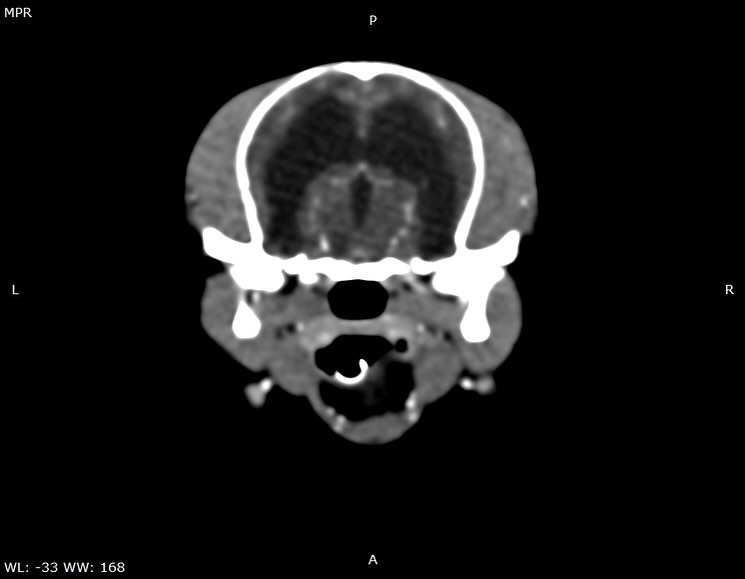 TAC: Hidrocefalia obstrutiva por estenose do aqueduto (imagem 1 de 3)
