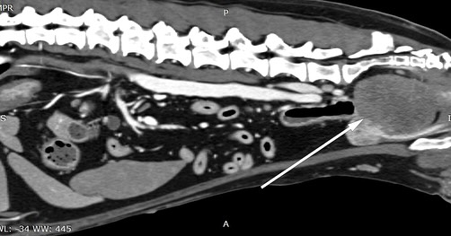 Oncologia: Leiomioma retal com obstrução intestinal (imagem 1 de 3)