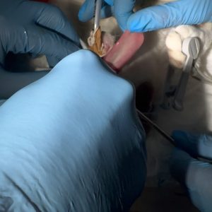 Endoscopia: Remoção de pólipo por endoscopia (imagem 2 de 2)