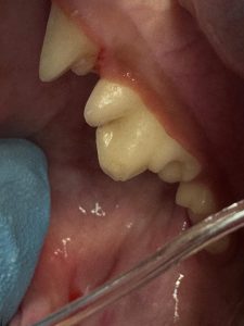 Dentisteria e Odontologia: Fratura dentária por objetos rígidos (imagem 5 de 5)