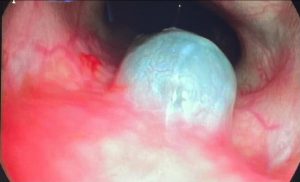 Endoscopia: Sialocelo nasofaríngeo em bulldog francês