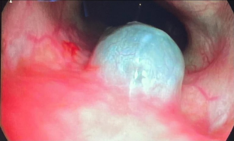 Endoscopia: Sialocelo nasofaríngeo em bulldog francês