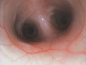 Endoscopia: Broncoscopia e lavagem broncoalveolar (imagem 1 de 2)