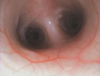 Endoscopia: Broncoscopia e lavagem broncoalveolar (imagem 1 de 2)