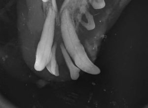 Dentisteria e Odontologia: Doença periodontal terminal em caso extremo (imagem 5 de 9)