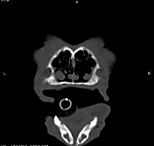 Dentisteria e Odontologia: Abcesso periapical e sinais respiratórios (imagem 2 de 4)
