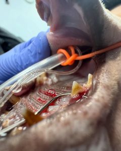 Dentisteria e Odontologia: Furca de grau 3 e exploração oral (imagem 2 de 2)