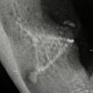 Dentisteria e Odontologia: Exodontia com raízes dilaceradas (imagem 2 de 3)