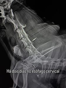 Endoscopia: Osso impactado no esófago removido por endoscopia (imagem 2 de 5)