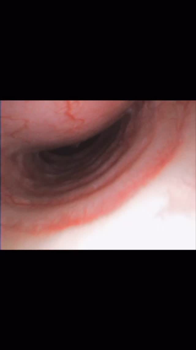 Endoscopia: Colapso traqueal em cães pequenos