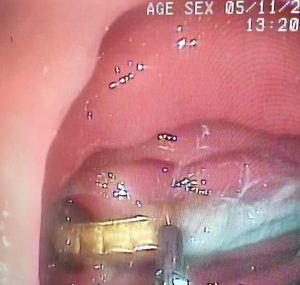 Endoscopia: Gastroscopia remove corpo estranho em gato (imagem 2 de 3)