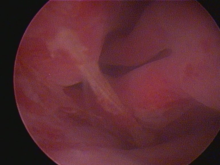 Endoscopia: Espigas em cães: remoção com endoscopia