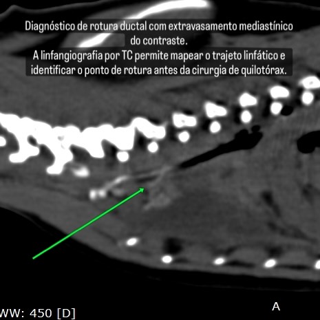 TAC: Linfangiografia por TC no quilotórax