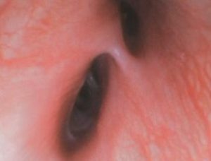 Endoscopia: Colapso brônquico em cães (imagem 2 de 3)