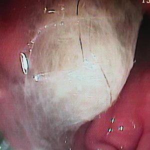 Endoscopia: Tricobezoares em gatos: quando preocupar (imagem 1 de 2)