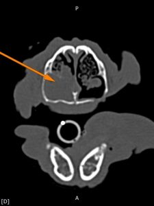TAC: Corrimento nasal com origem dentária (imagem 3 de 3)