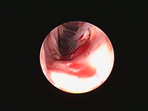 Endoscopia: Quisto laríngeo em cão com estridor (imagem 2 de 3)
