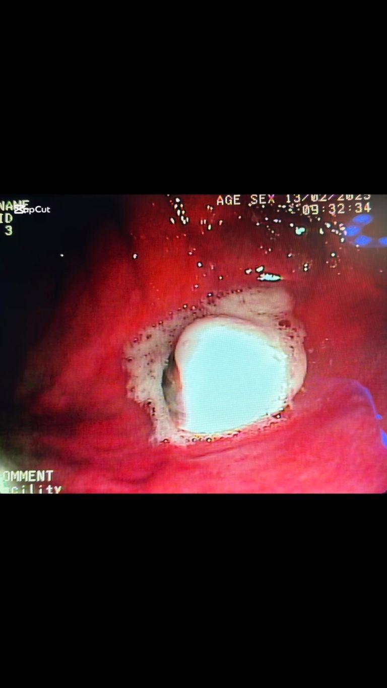Endoscopia: Remoção endoscópica de uma concha