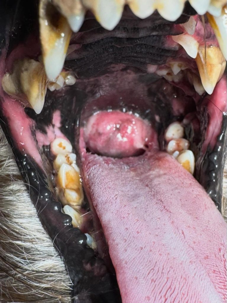 Oncologia: Melanoma tonsilar sem pigmentação (imagem 1 de 2)